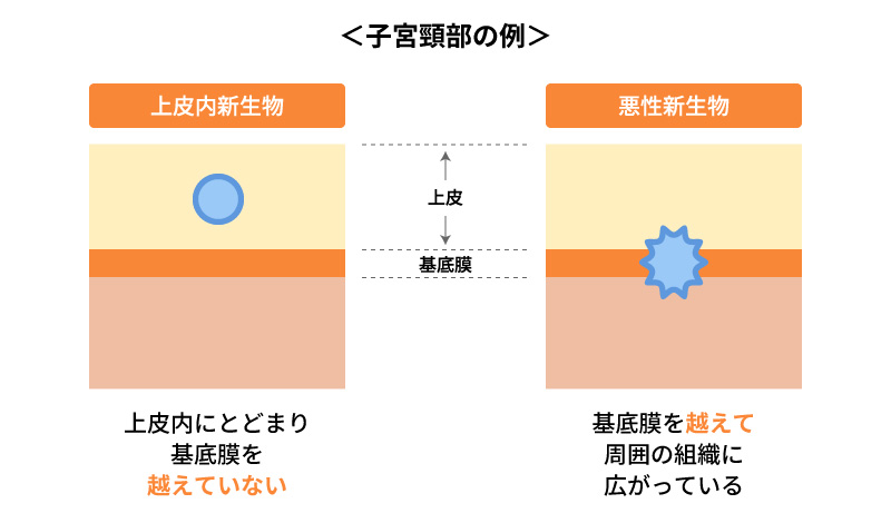 上皮内新生物と悪性新生物のイメージ図（部位により異なる）