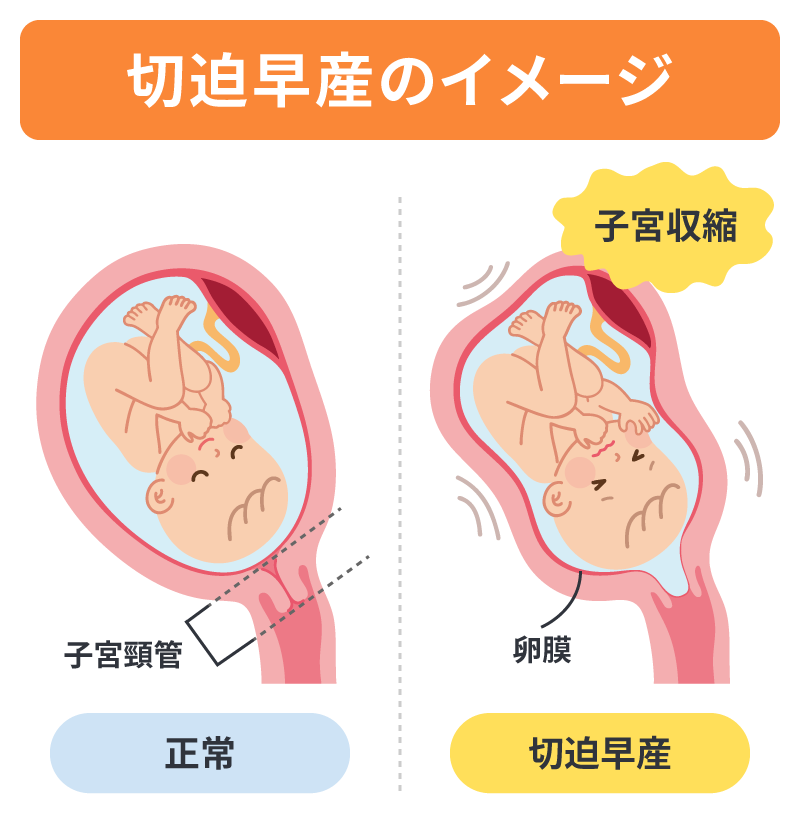 切迫早産のイメージ